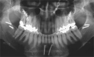 Ортопантомограмма - обзорный рентгеновский снимок зубных рядов