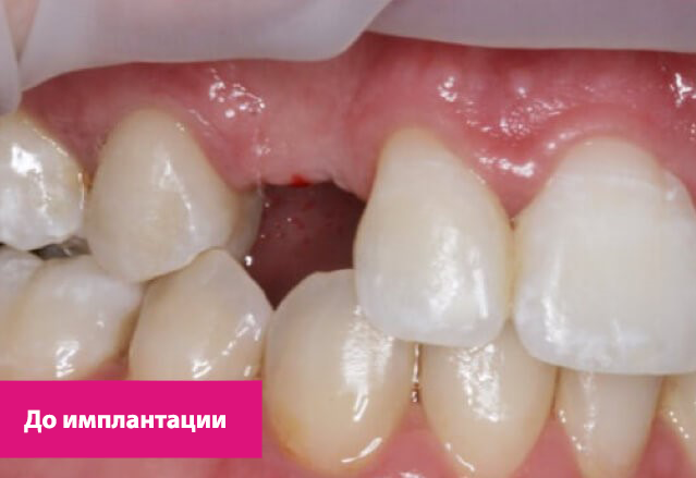 Одномоментная имплантация зубов 1.png